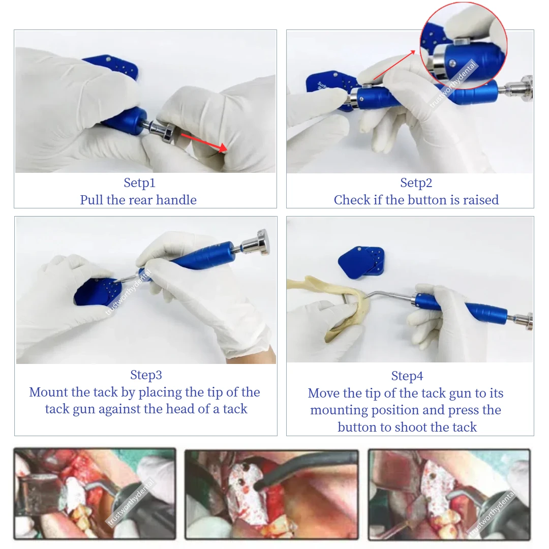 Dental GBR Automatic Bone Tack Gun Kit Bone Tac Auto Gun Membrane Titanium Tacks Guide Automatic Auto Tacs Gun MCTBIO Type