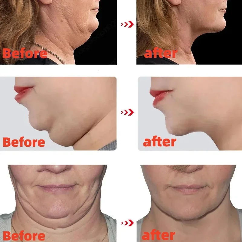 V Shape Slimming Cream Firming Face-lift Remove Masseter Muscle Double Chin Tighten Fat Burning Cream Fade Neck Lines Products