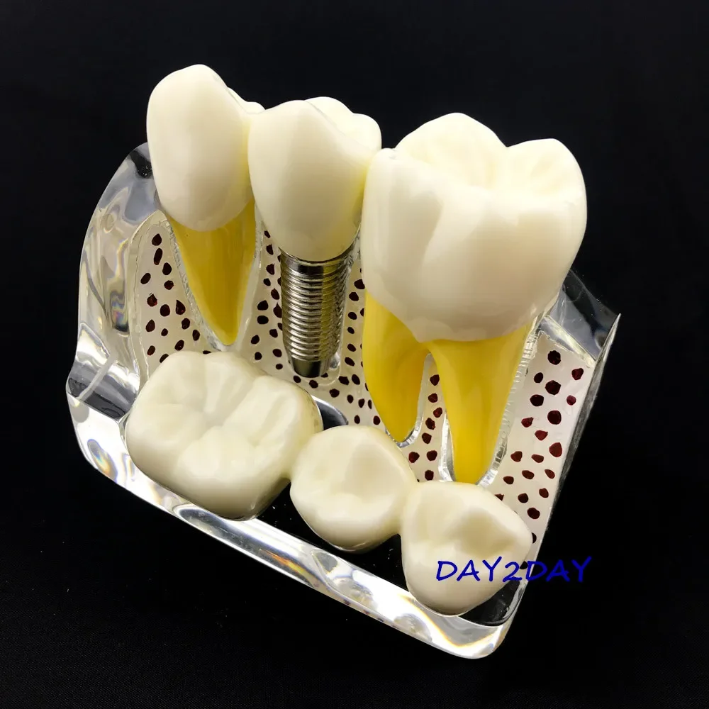 نموذج تعليمي عن طريق الفم # 2017X نموذج قابل للإزالة لجسر التاج لتعليم الأسنان نموذج لشكل الأسنان