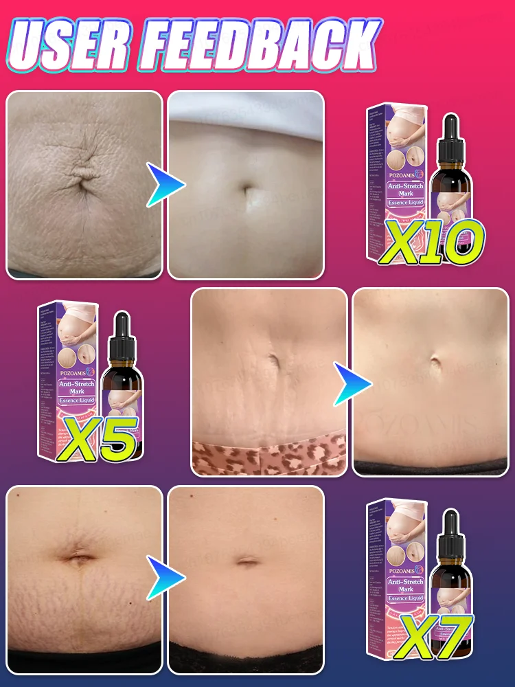 Massage Essence Oil for Stretch Mark & Scar Skin, Help Soften Dry Rough Skin Texture, Improve Visible Stretch Mark Appearance, Deep Hydrating Body Skin Serum