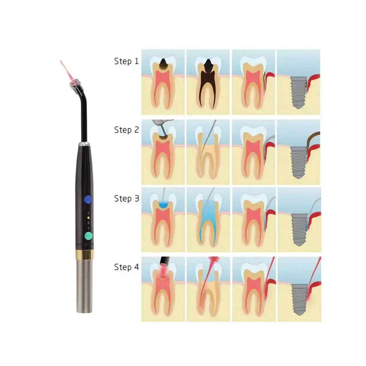 Wireless Dental Laser Pointer 650nm Low Light Infrared Oral Disinfection Pulp Periodontal Implant Repair Tool