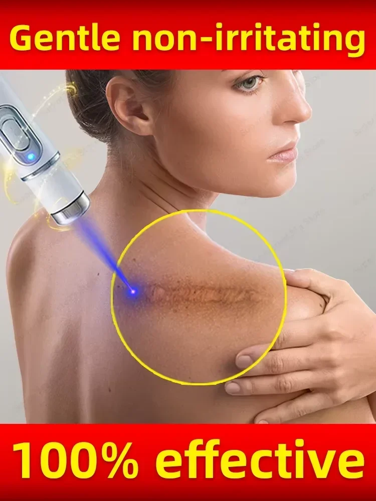 

Laser highly effective keloid repair