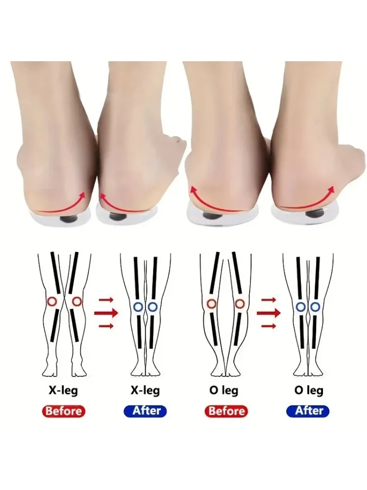 1 paar Orthopädische Einlegesohlen für Füße O/X Bein Typ Valgus Korrektur Männer Frauen Silikon Gel Schuhe Einlegesohle magnet Massage Schuh Pads
