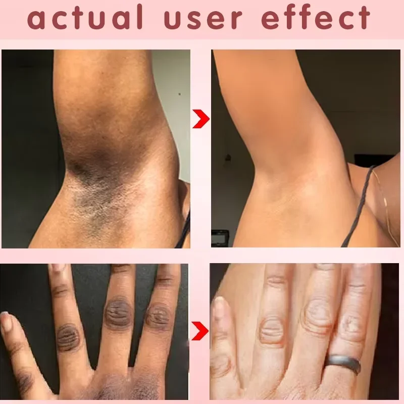 New Dark Knuckles Fast Brighten Serum Elbows Hand Knuckle Brightening Serum Knee Black Skin Spot Lighten Stains Remover Essence