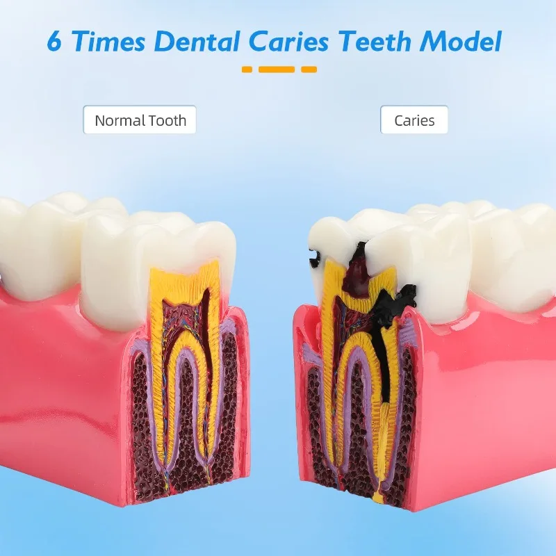 Dental  6Times Caries Teeth Model  Anatomy Education Model  Caries Bilateral Comparison Study Model Tooth Decay Props Teaching