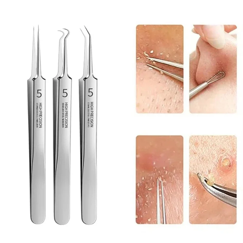 3pcs Stainless Steel Blackhead & Blemish Remover Set - Precision Tools for Face & Nose -Acne Extraction for Whiteheads & Pimples