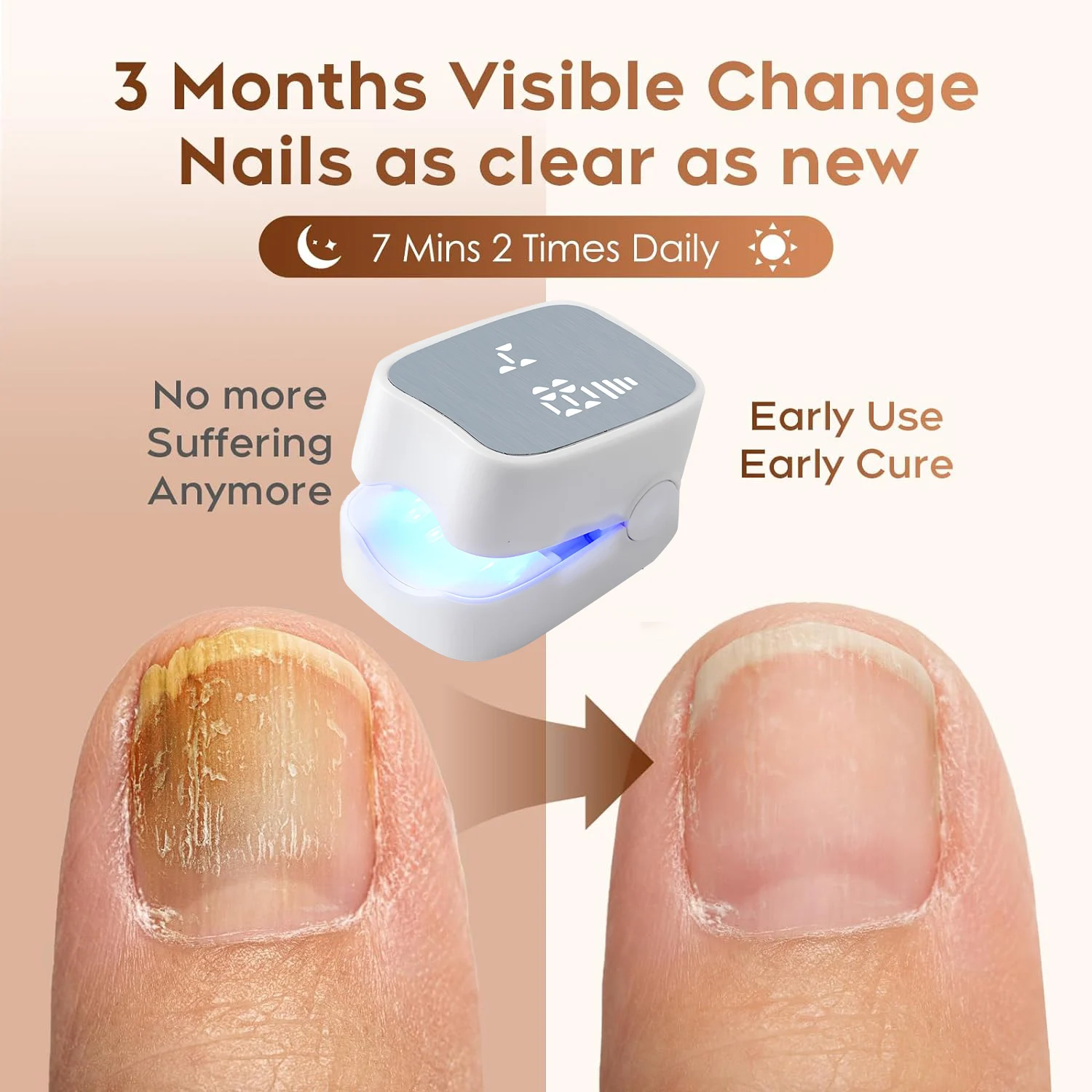 Manicure Care Nail Fungus Laser Treatment Device Onychomycosis Therapy Cure Machine for Broken Cracked Split and Weak Nails
