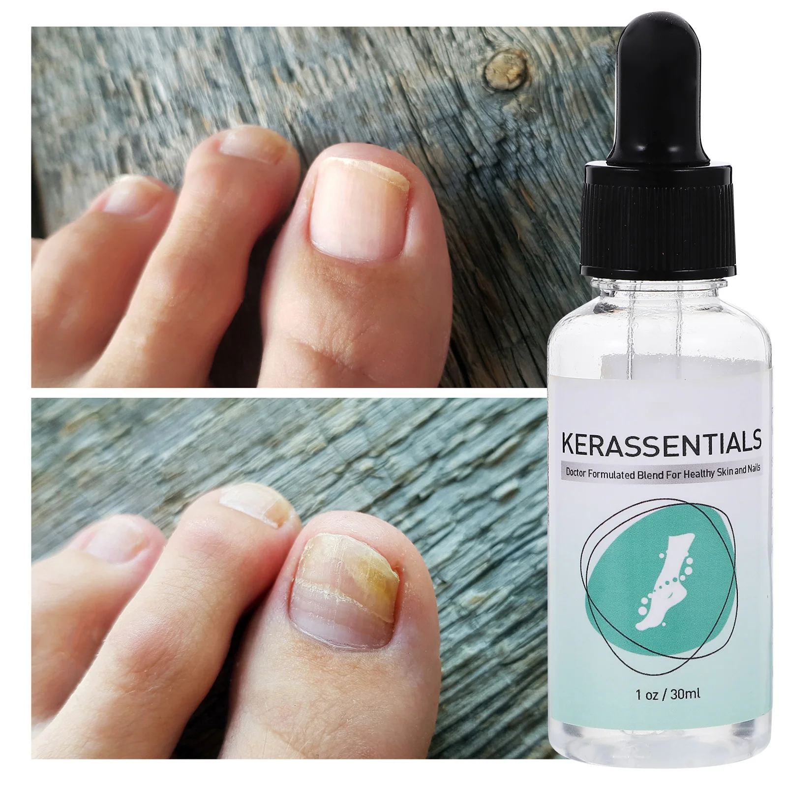 Teenreparatiebehandeling voor schimmelnagelbehandeling voor vingernagel Teennagel Vingernagelverdikkingsoplossing Nagelgezondheidszorghulpmiddel