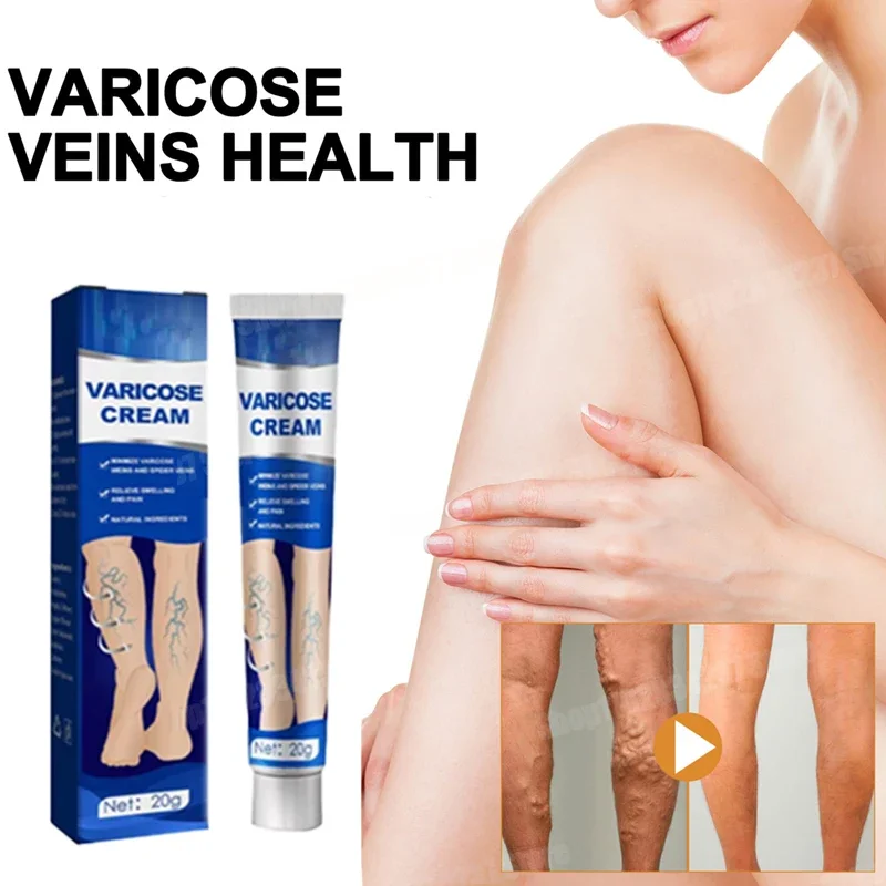 Varicose Veins Relief Of Dilated Vasculitis In The Legs Phlebitis Improved Blood Circulation