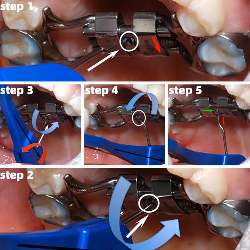 Imagen 2 del producto Llaves giratorias de ortodoncia dental universales: kit de herramientas de ajuste de tornillo de expansión de implante y expansor palatal rápido