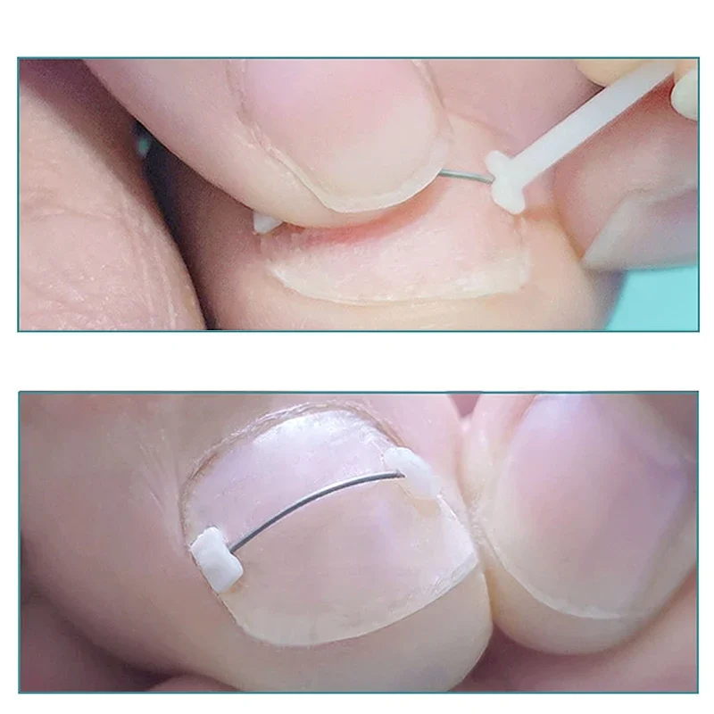 Ingrown Toenail Correction Tools Professional Treatment Recover Embed Toe Nail Device Pedicure Podiology Straightening Toe Tools