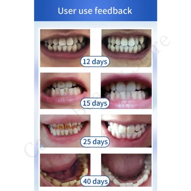 Dentifrice pour l'élimination du calcul dentaire, nettoyage des dents, blanchiment, élimination de la mauvaise haleine et de la plaque dentaire, prévention de la parodontite, soins de réparation des caries