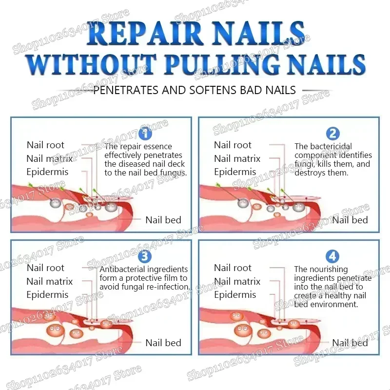 Раствор для восстановления ногтей, утолщение, яркие ногти, удаление онихомикоза, восстановление омертвевшей кожи, увлажняющий раствор для ухода за ногтями, питательный раствор