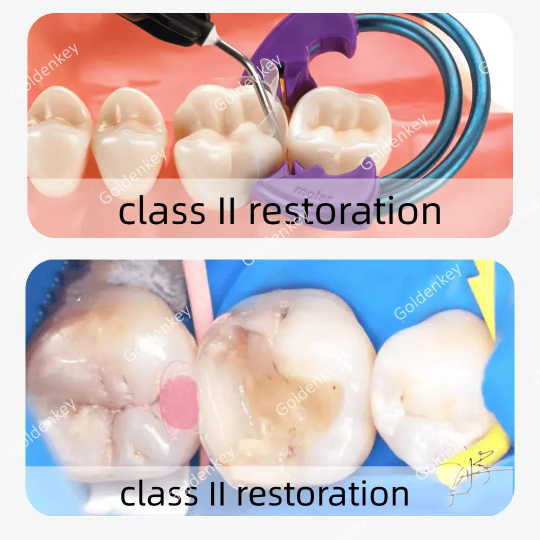 Dental Clear Matrix Posterior Fits Bioclear Transparent BT Matrices Molar Composite Class Restorative 4.5/5.5/6.5/8.0 0.038mm
