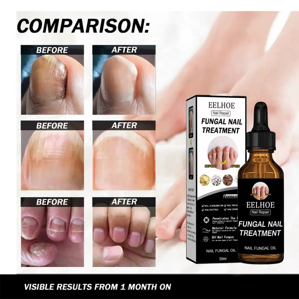 30/50ML Nail Repair Liquid Onychomycosis Rapid Relief Oil Nail Care Fungul Nails Treatment Liquid Paronychia Anti Infection