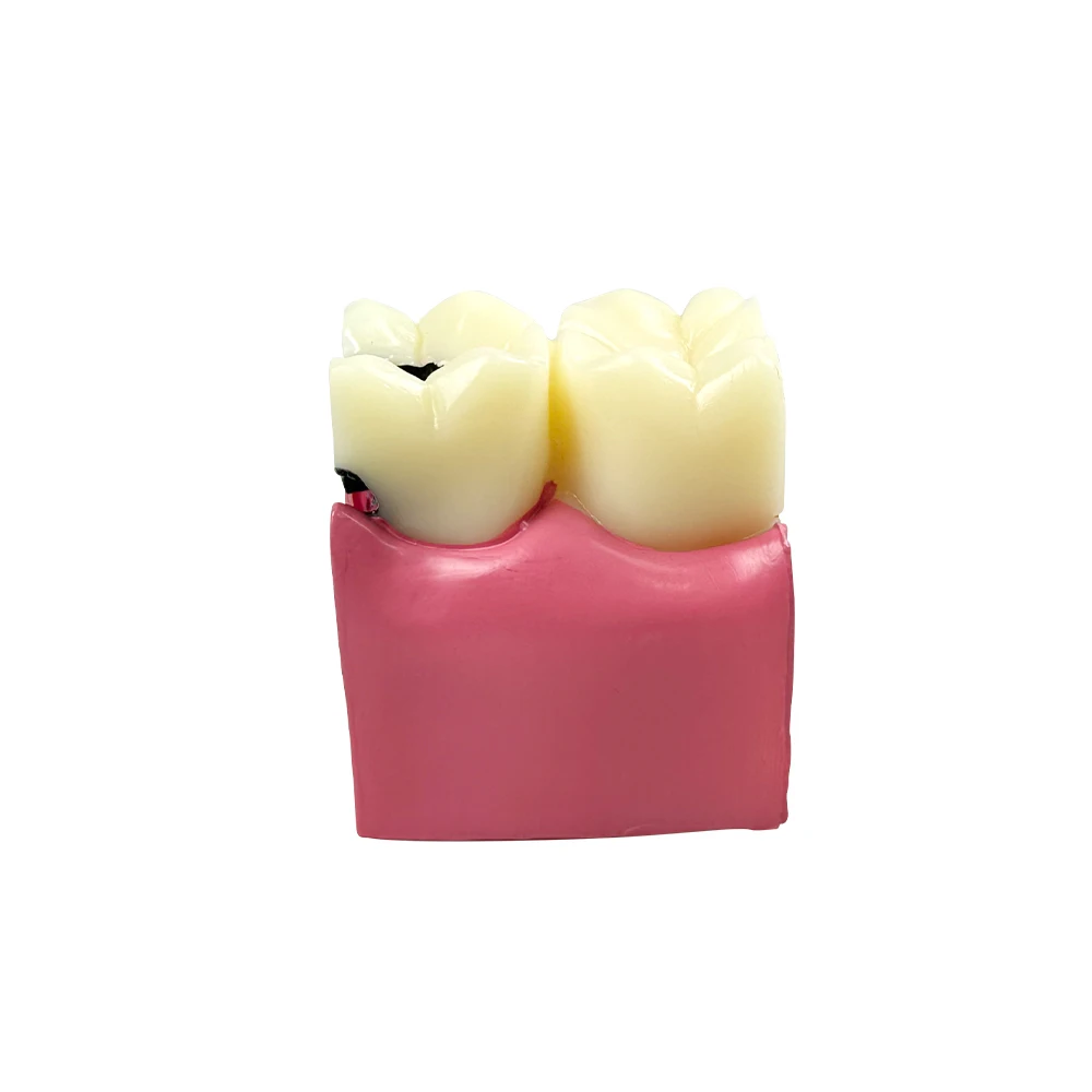 6 Times Dental Caries Teeth Model Pathological Molar Cross Section Model Tooth Decay Comparsion Study Demonstration Model
