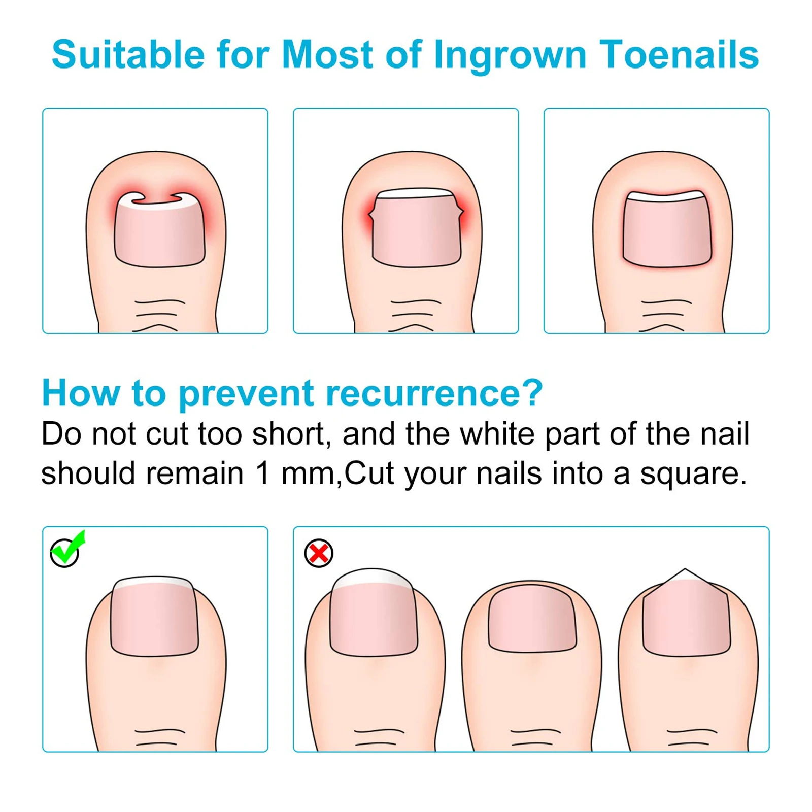 

50 Pcs Armor Correction Patch Toenail Clip Straightening Patches Pedicure Ingrown Corrector Foot Care Synthetic Fiber and Resin