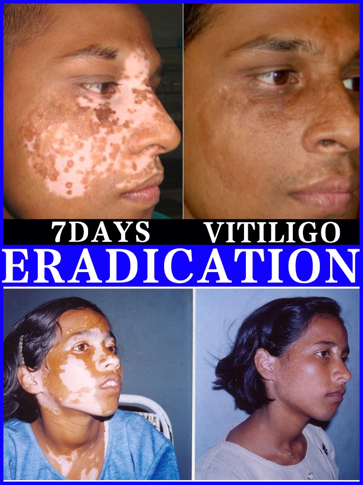 

Vitiligo ointment is effective in repairing the skin