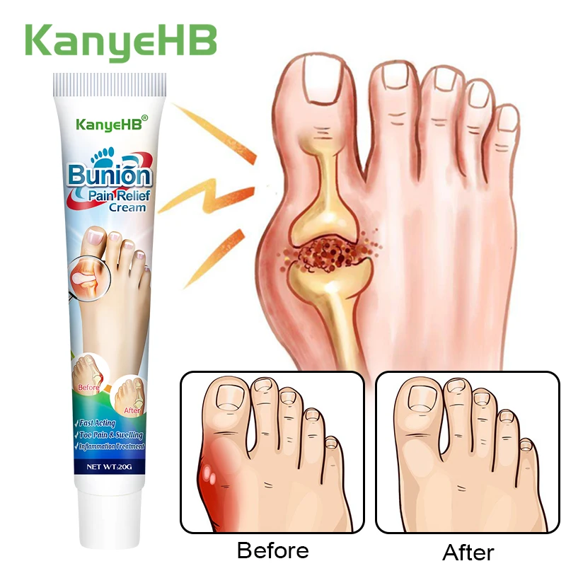 1Pcs Foot Gout Treatment Cream Thumb Corrector Finger Hallux Ointment Toe Bunion Pain Relieve Medical Plaster Health Care G019