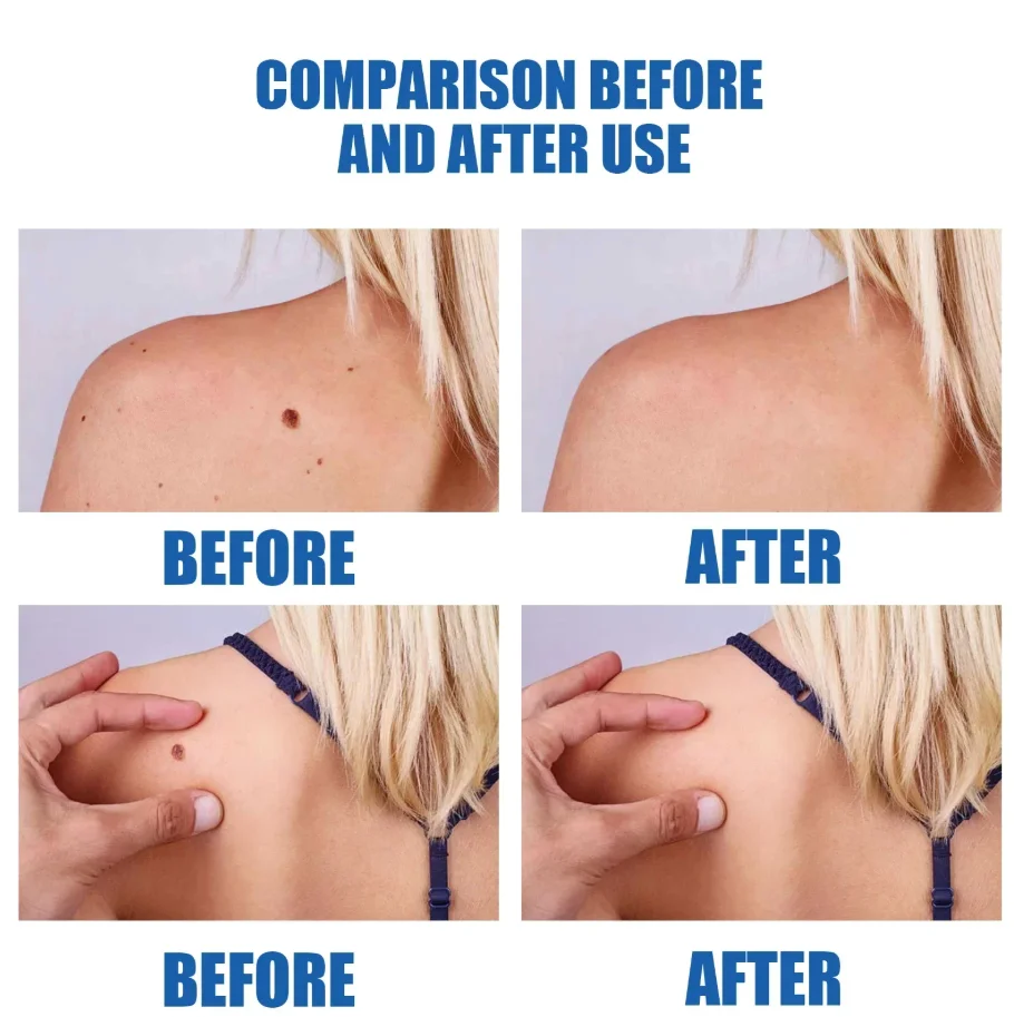 عرض ساخن لعام 2025، قلم الضوء الأزرق يحل الثآليل، أدوات العناية بالثآليل، للجنسين #3