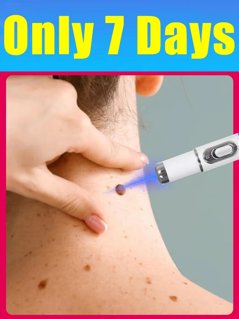 2026NEW blue light laser pen to solve neck warts, hot wart care tools.