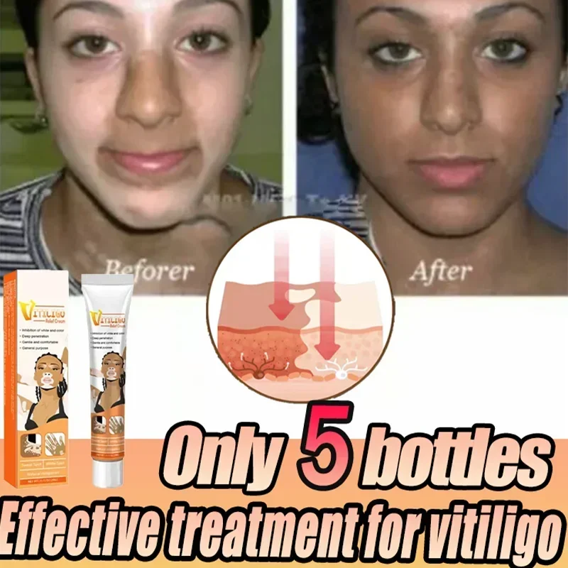 

Vitiligo Removal Cream White Spot Care Cream Skincare cream vitiligo skin Sweat spot Reduce white spots Skin care