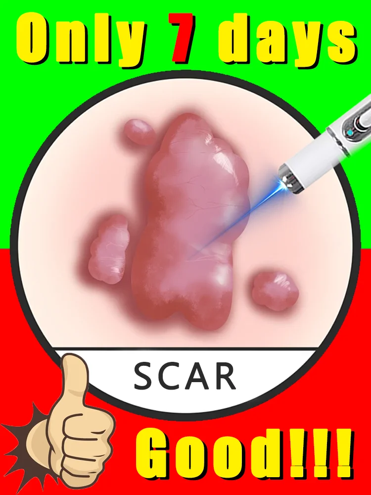 

[2025 New]Generation-2 Laser Says Goodbye,free shipping,blue light pen solve scar,hotsale scar care tools,painless,free shipping