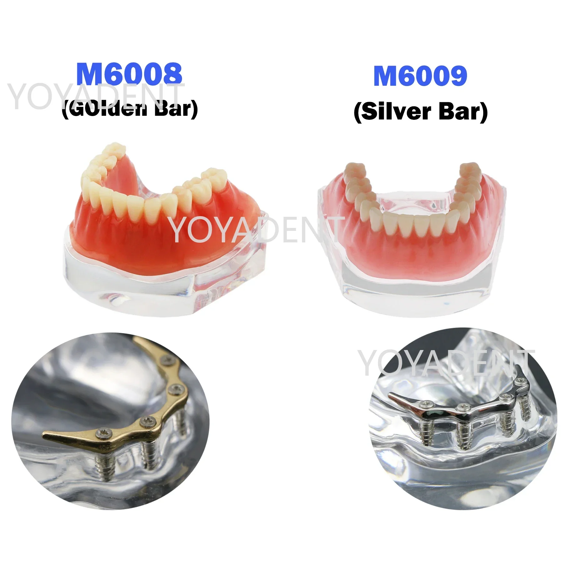 Dental Teeth Model Removable Overdenture Lower Jaw 4 Implant Teeth  For Dentist Communication Patient Teaching