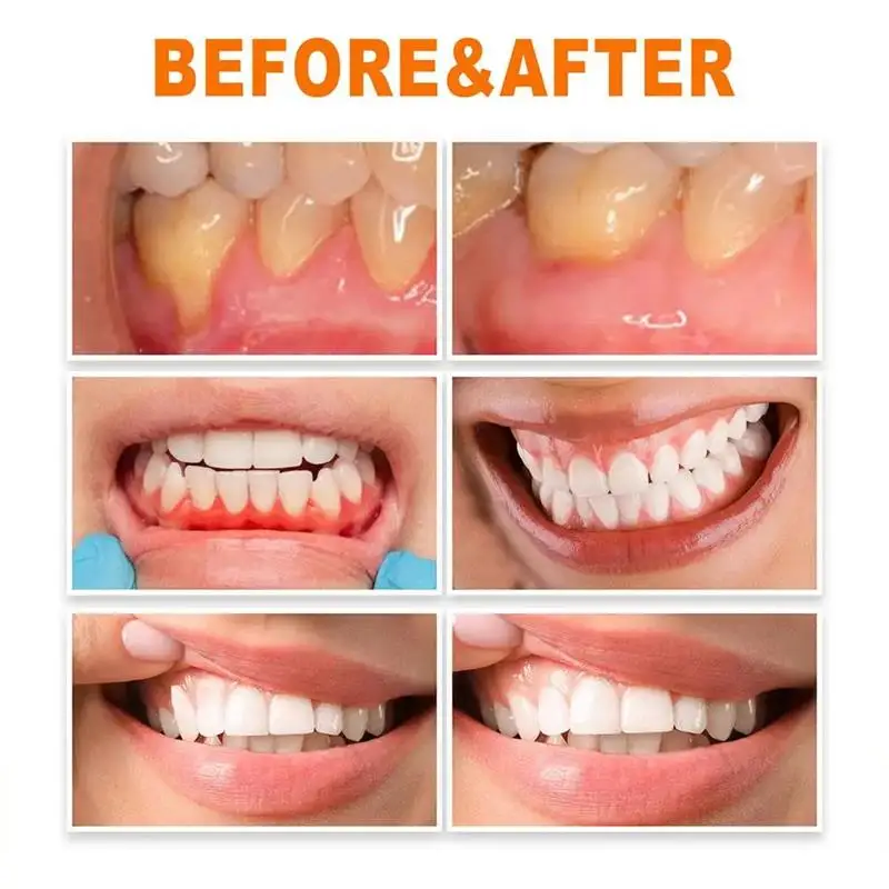 Reparar rapidamente goma soro cuidados dentes branquear remover amarelo reparação goma recrescimento placa manchas aliviar gengivas cárie dor de dente