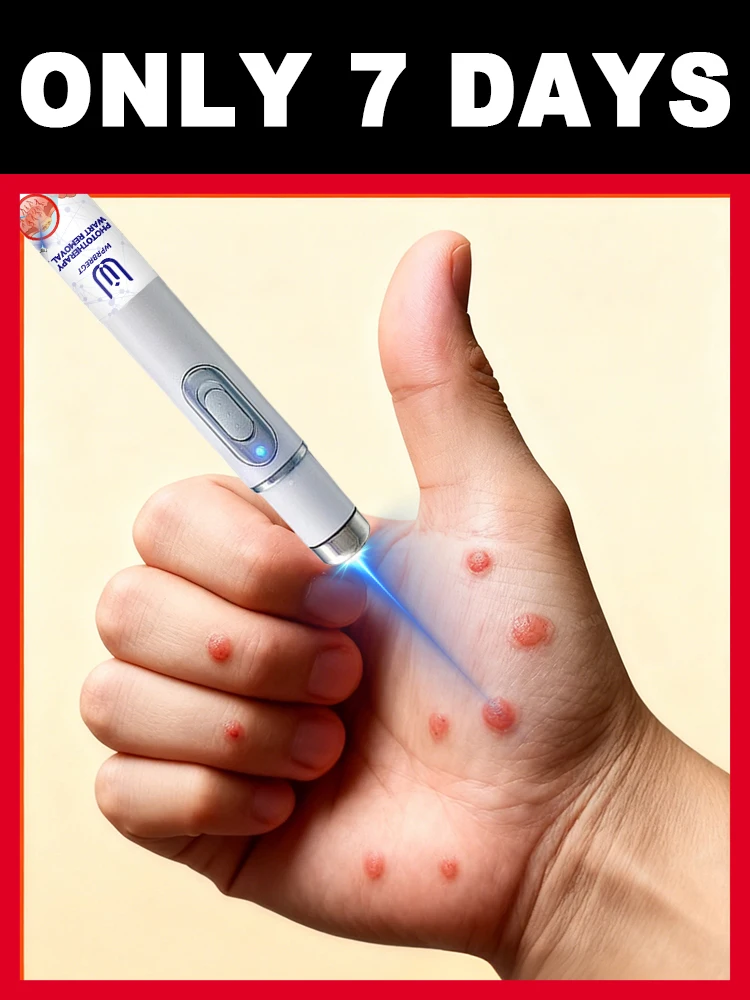 

Laser pen not only removes surface warts, ᵇᵘᵗ ᵃˡˢᵒ ʳᵉᵈᵘᶜᵉˢ ˢᵘᵇˢᵉᑫᵘᵉⁿᵗ ʳᵉᵍʳᵒʷᵗʰ