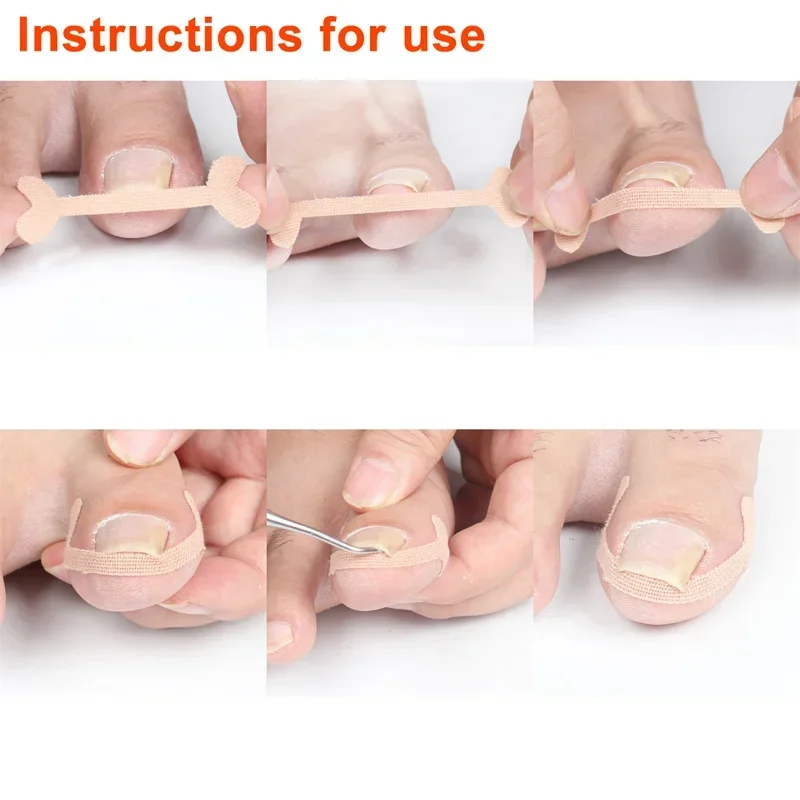 Ingrown Toenail Corrector Sticker Nail Strip Anti-roll Nail Free Glue Toe Inlay Nail Corrector Patch Correction Stickers Toenail