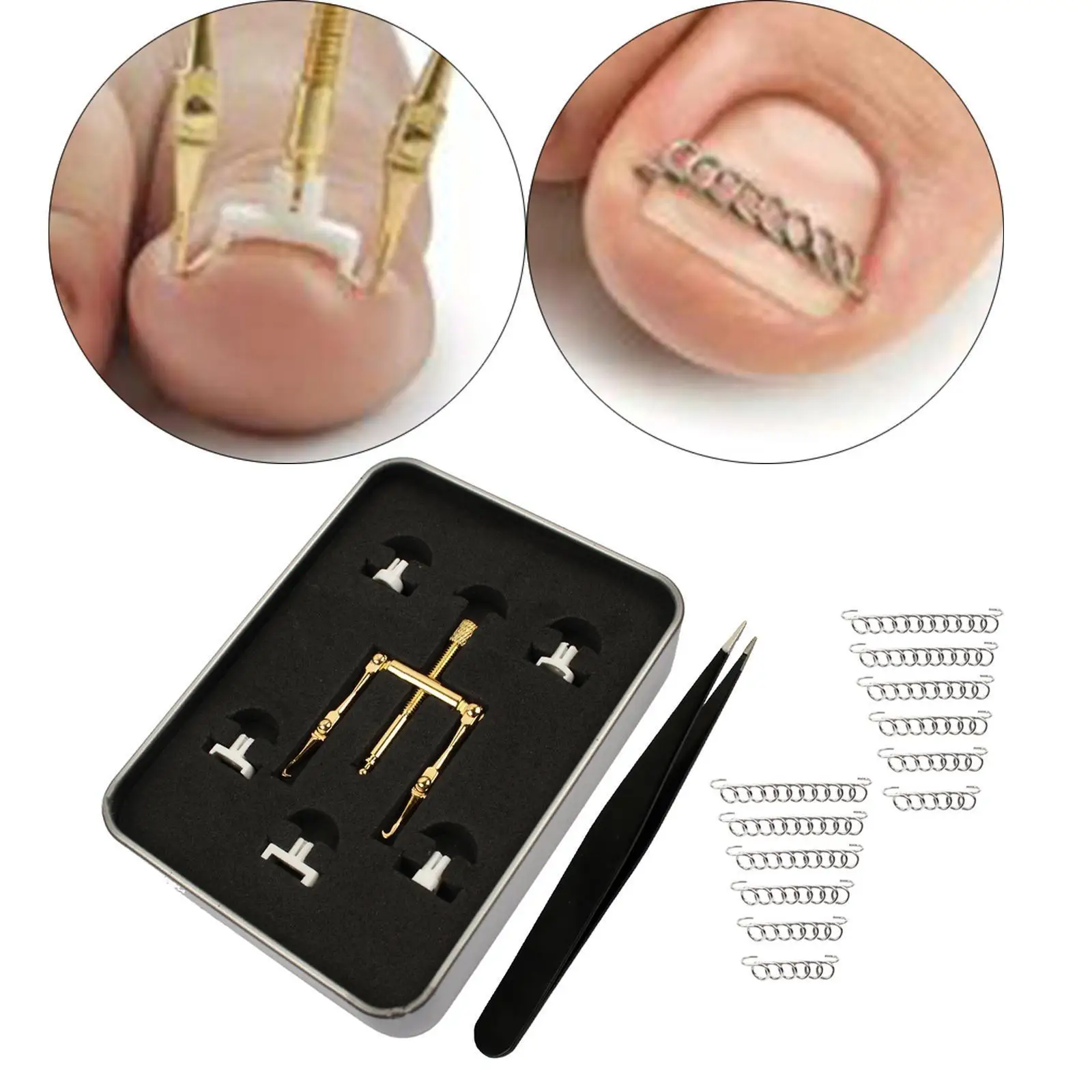 علاج أظافر القدم الغارزة، مشبك تنعيم للأظافر