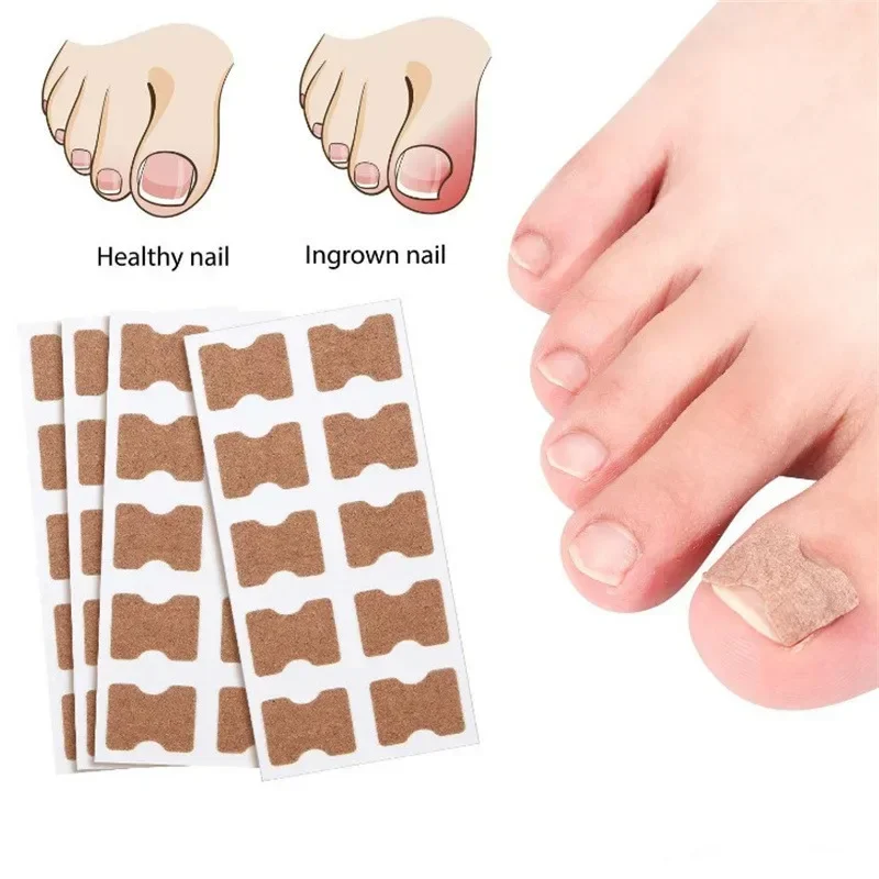 20Pcs Ingrown Toenail Corrector Patches Nail Correction Care Stickers Paronychia Treatment Recover Corrector Pedicure Tool