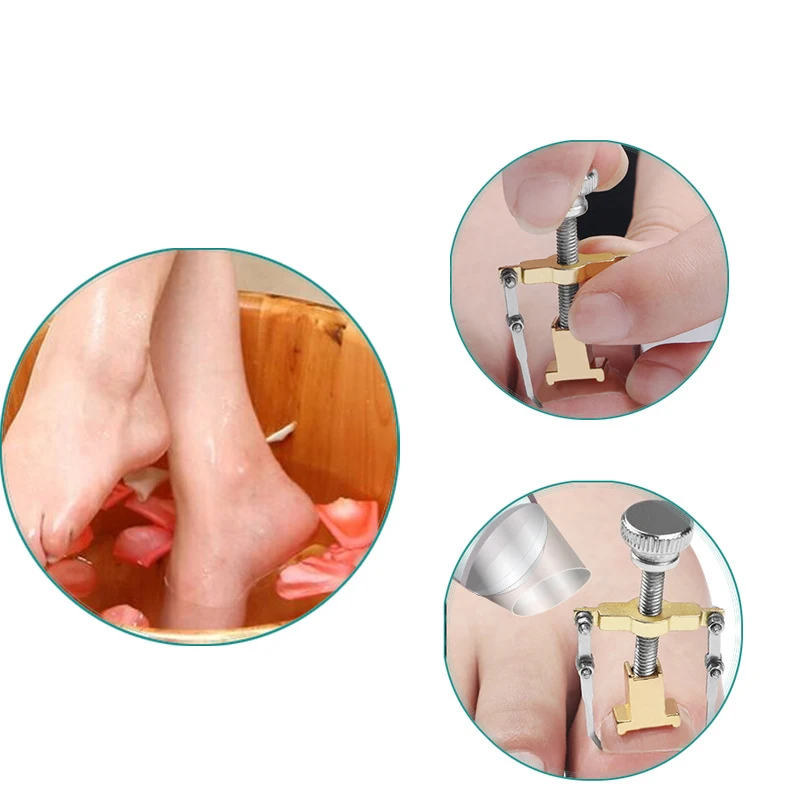 1pc Correction of Paronychia with Toe Nail Correction Bracket for Treatment of Toe and Toe Care with Toe Fixator image 3