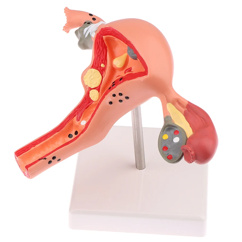 1Pcs Medical Props Model Pathological Uterus Ovary Anatomical Model Anatomy Cross Section Study Tool