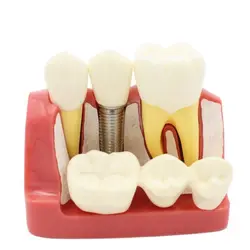 Crown Bridge PerfecModel pour l'enseignement dentaire, analyse d'implant dentaire, démonstration dentaire, modèle de dents