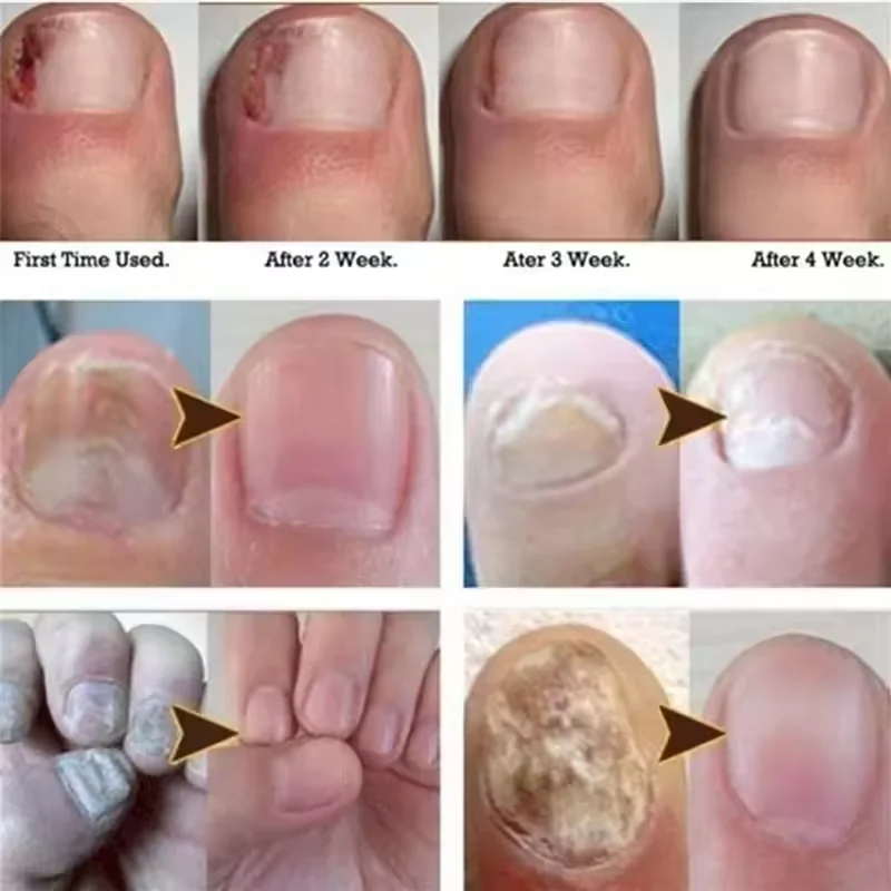 Nail Fungus Treatment Serum Treatment Toe Nails Fungal Removal Essential Oil Anti Infection Paronychia Onychomycosis Health Care