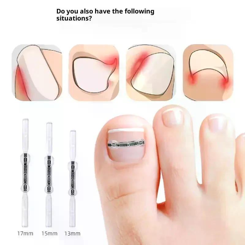 Werkzeuge zur Korrektur eingewachsener Zehennägel, Pediküre, Wiederherstellung, Einbettung der Zehennägel, professionelle Clip-Klammer zur Glättung eingewachsener Zehennägel