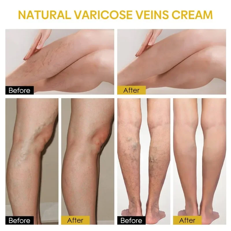 Bee Venom Varicose Vein Smooth Cream Effective Relieve Leg Spider Pain Vasculitis Phlebitis Swelling Repair Ointment Health Care