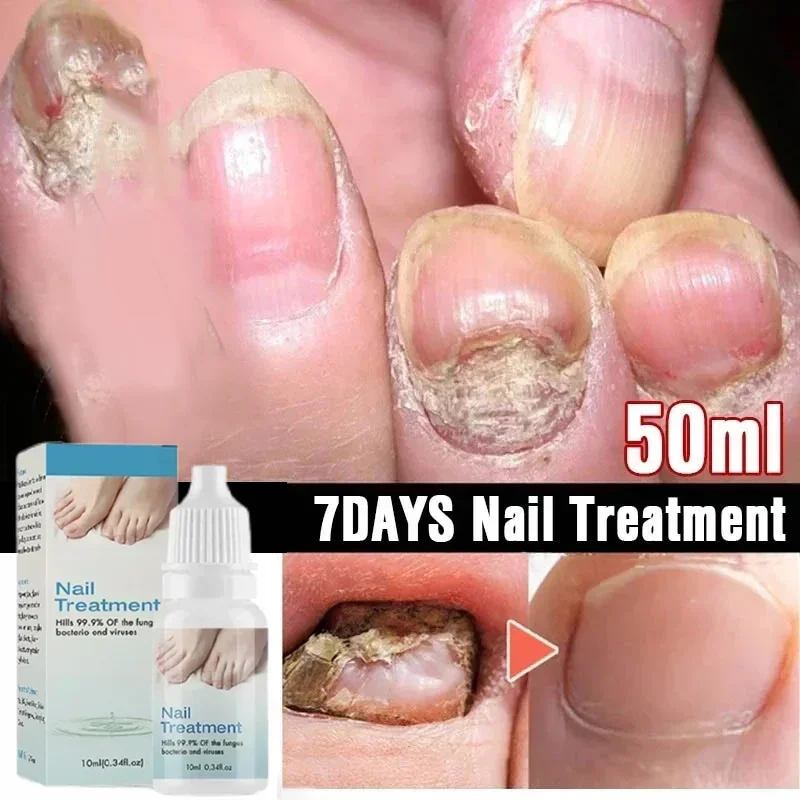 

Toe Nail Fungus Removal Gel with Anti-Infection Cream, Fast-Acting Formula, 10ml