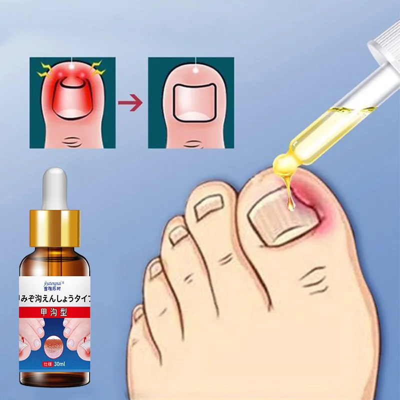 Jiyatengnai نوع الأخدود للأظافر محلول الرعاية الصحية الخارجية يهدئ أظافر القدم الغامضة والانتفاخ والازعاج حل مسحة الرعاية الخارجية