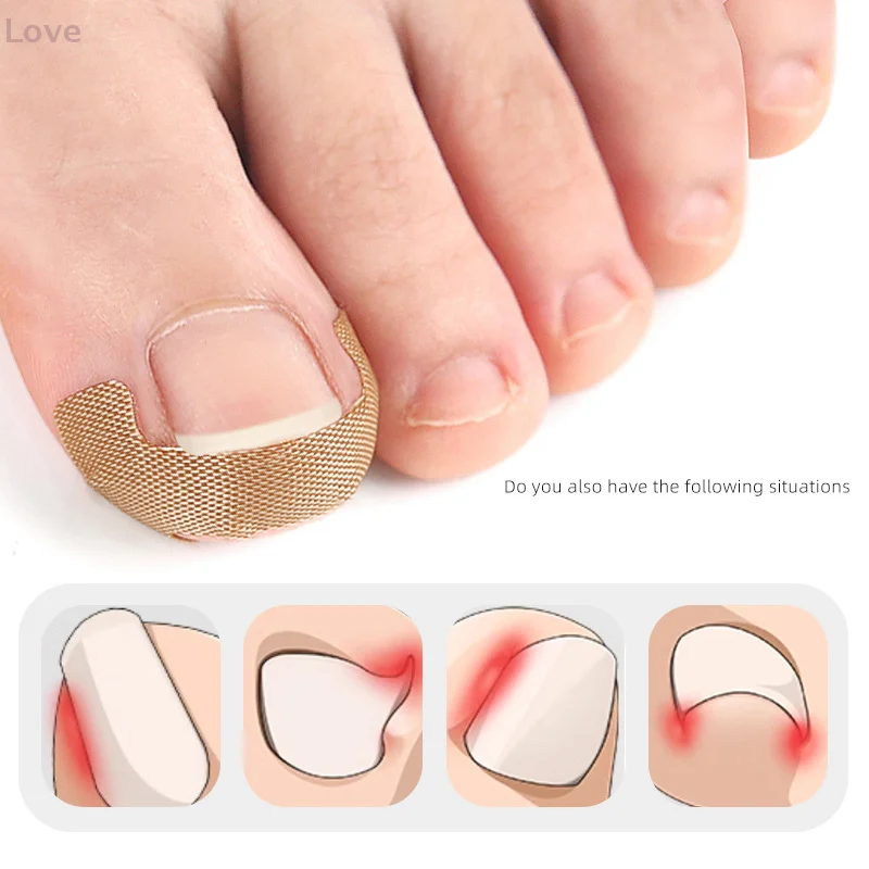 5 hojas de parche para tratamiento de uñas, antiinfección, paroniquia, onicomicosis, uñas encarnadas, ranura, corrección de hongos, pegatina de reparación