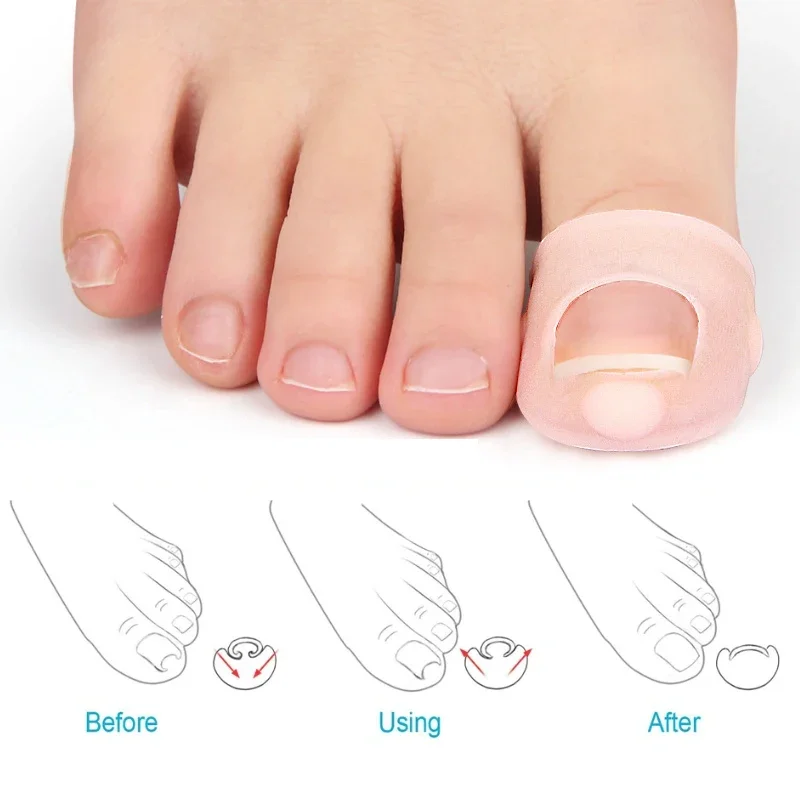 Silicone Ingrown Toenail Correction Tool Invisible Ingrown Toe Nail CoverElastic Straightening Clip Brace Foot Tool
