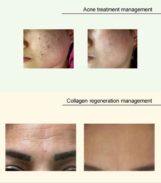 Profesjonalna maszyna plazmowa 2w1 ozonowa powieka Lifting twarzy pielęgnacja twarzy odmładzanie skóry urządzenie do usuwania zmarszczek Salon urody