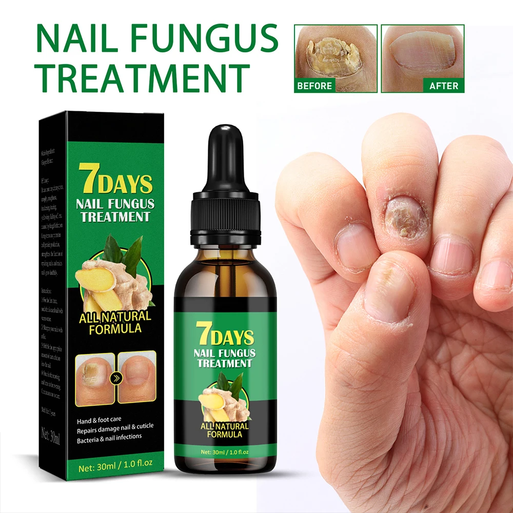 Fungal Nail Laser Device Nails Fungus Fast Repair Onychomycosis Toenail Fingernail Removes Nail Fungus Foot Care Cure Ingrown