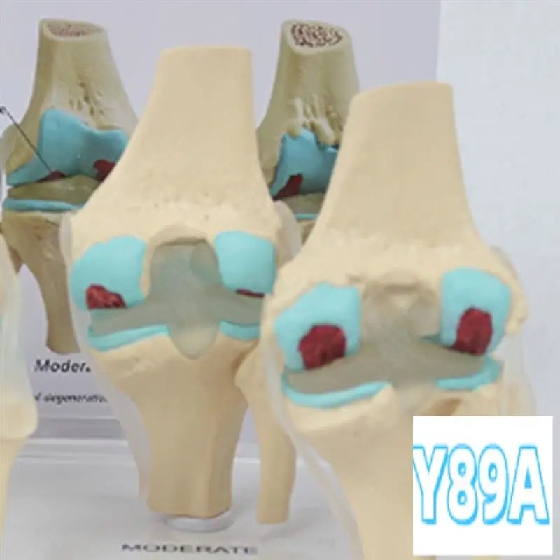 

GO-Knee Kit Osteoarthritis Anatomy Model With Educational Key Card 4 Stage Knee Model Orthopedic Teaching Aids