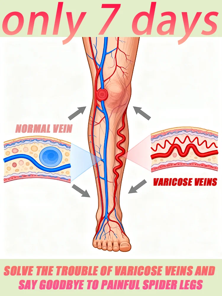 

Laser treatment for varicose veins, ᴍᴇᴅɪᴄᴀʟ grade equipment, painless treatment for spider veins and blood in the legs