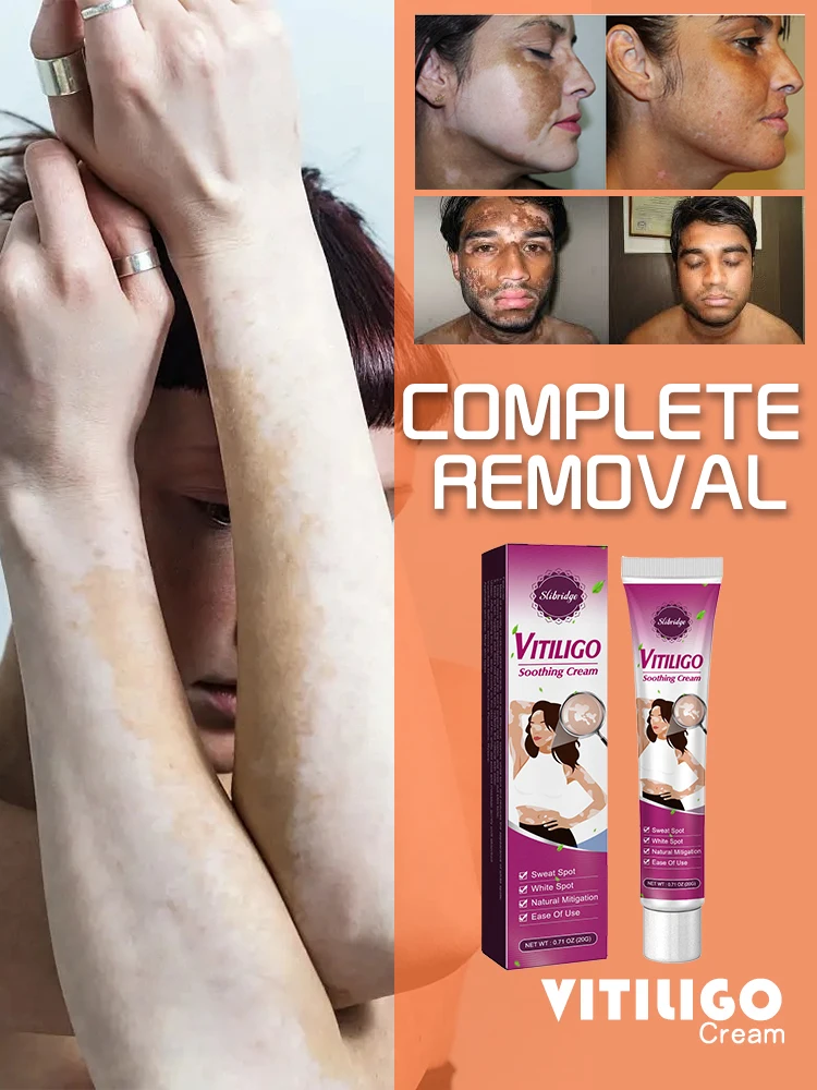 Vitiligo-Pommade mammaire, supprime activement l'élargissement des taches