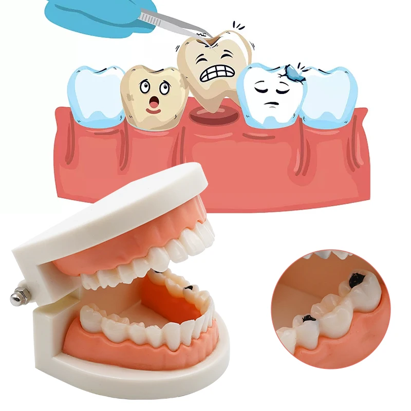 1pc Dental Model Dental Caries Model Teeth Periodontal Disease Model Dentist Material Dental Teaching Models Study