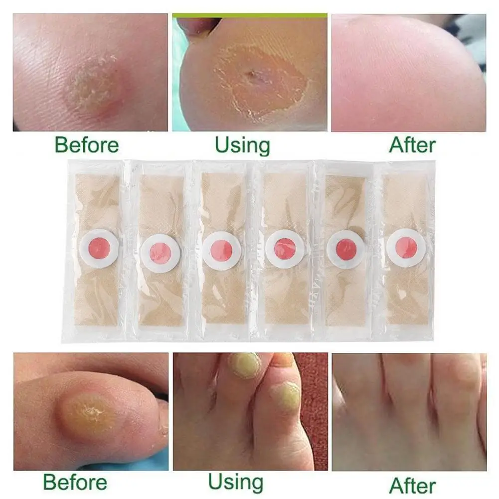 6PCS Schmerzlos Medizinische Pflaster Warzen Dorn Füße Kallus Huhn Auge Behandlung Aufkleber Fußpflege Ferse Pad Schaum Fuß Paste